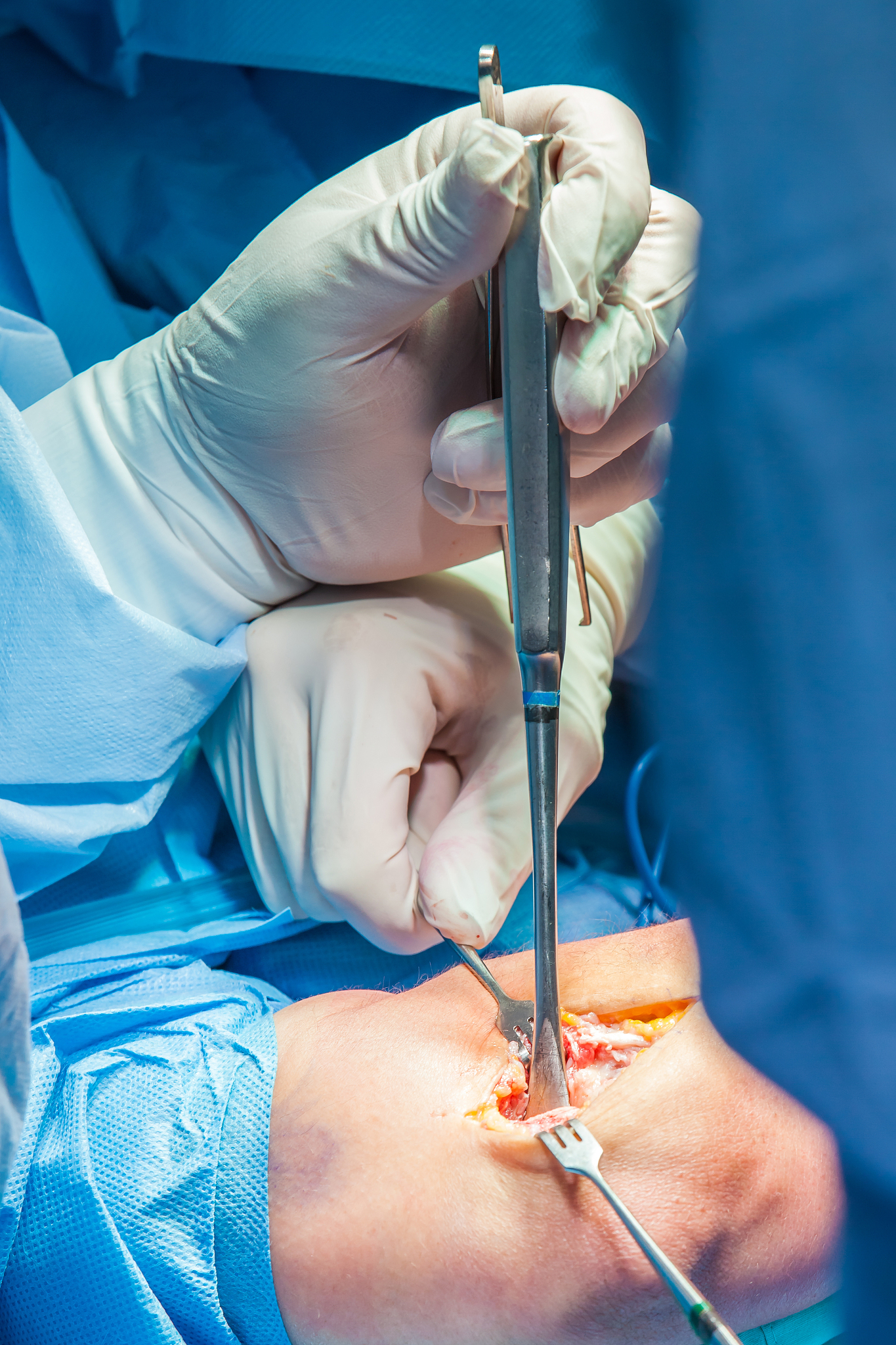 group of orthopedic surgeons performing surgery on a patient arm