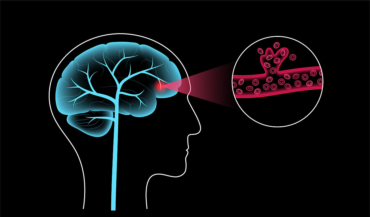 脑肿瘤：病因、症状及生活管理指南