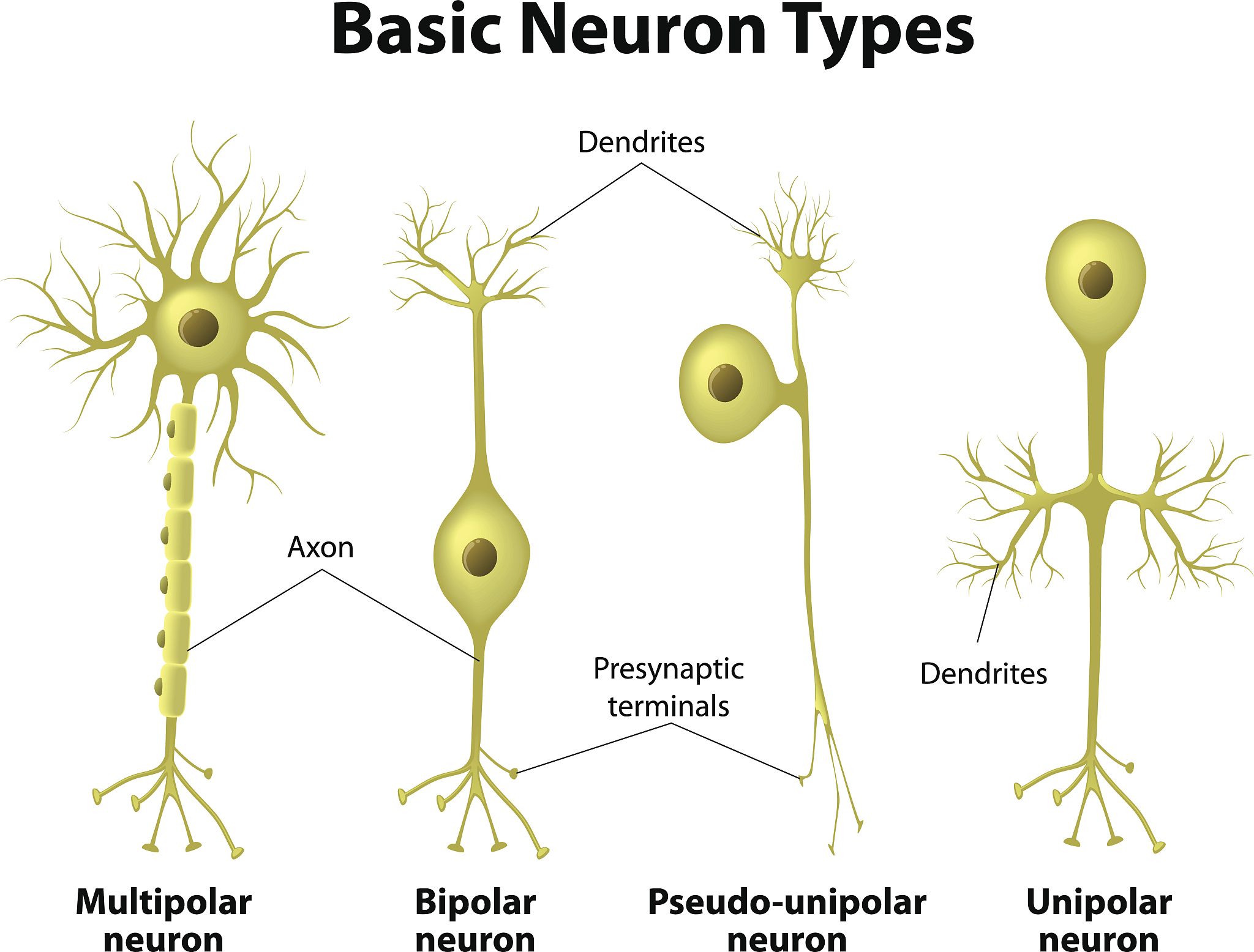 Lacunar Infarction in Caudate Nucleus: Case Study of a 56-Year-Old Male with Carotid Artery Stenosis