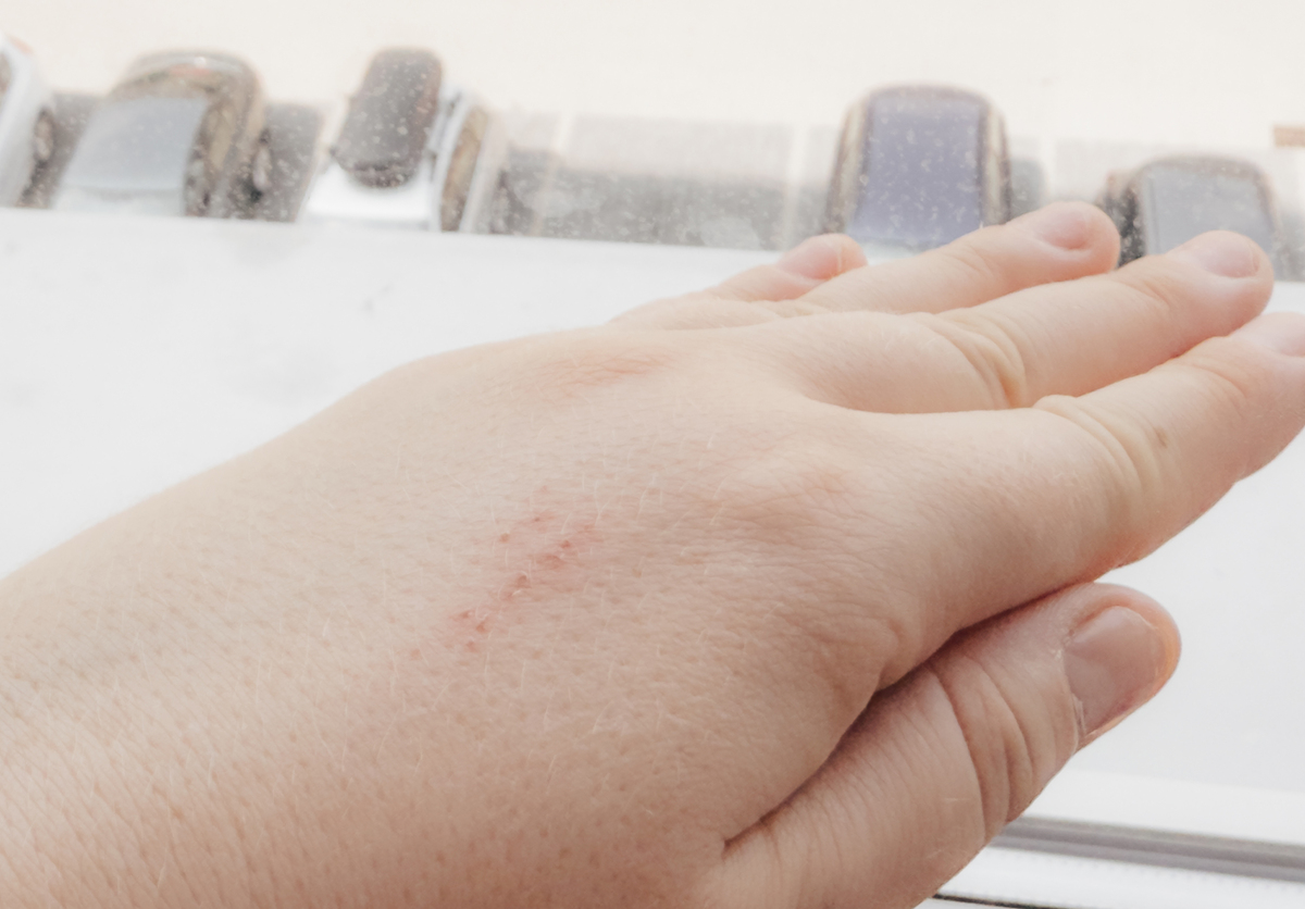 被猫抓伤会感染吗？风险高不高？