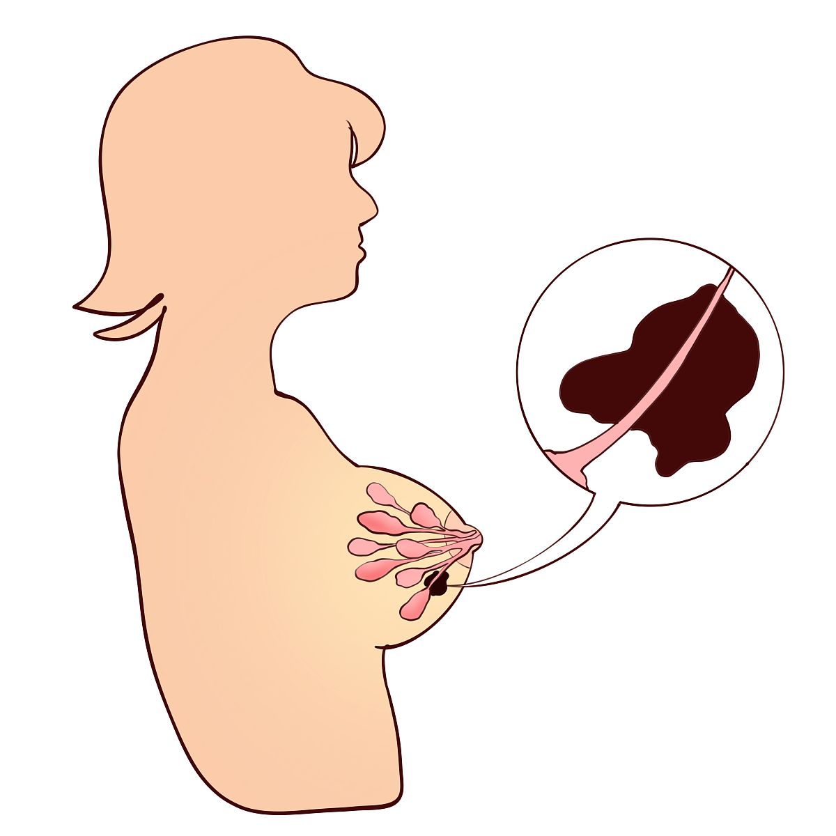 产后乳房胀痛难忍？了解产妇乳胀原因及缓解方法