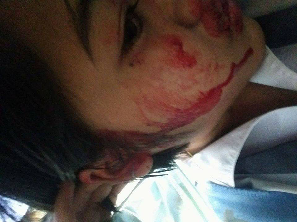 马拉色菌毛囊炎最有效的治疗方式