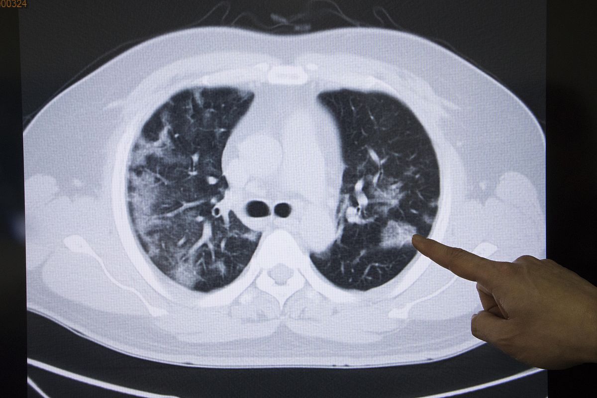 肺癌早期影像学表现：CT扫描识别关键征象