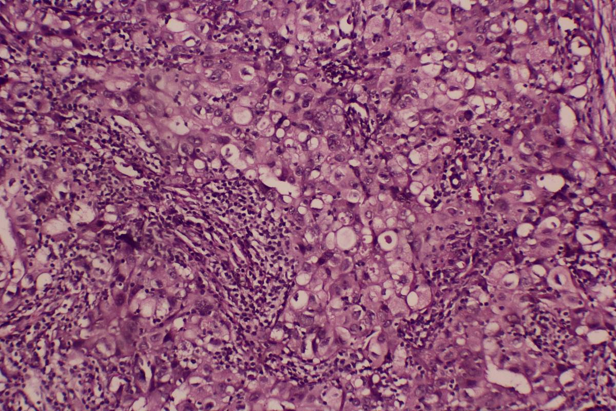 乳腺癌通常转移到哪些部位转移至不同部位相对应的治疗方法有哪些原因是什么占比分别是多少要求字数4000字
