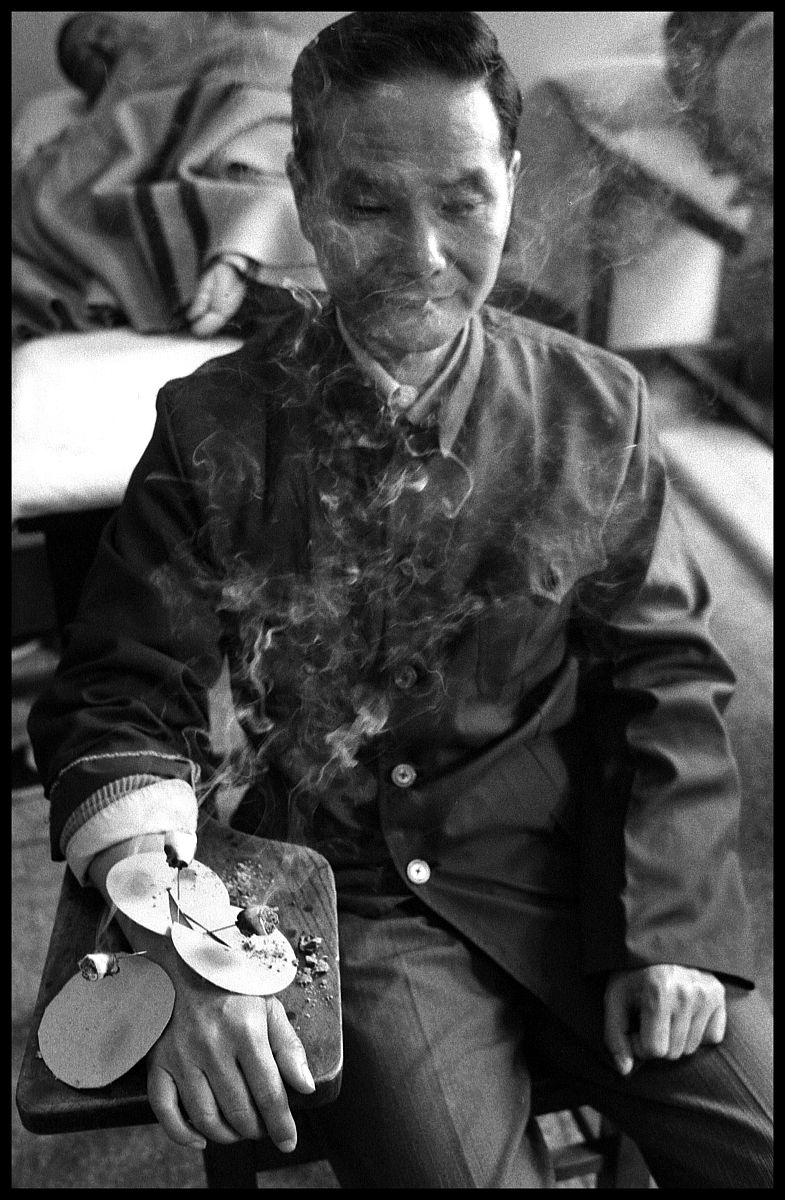 1980年代,上海,医院内做艾灸的病人.china - january 01:  care of pa
