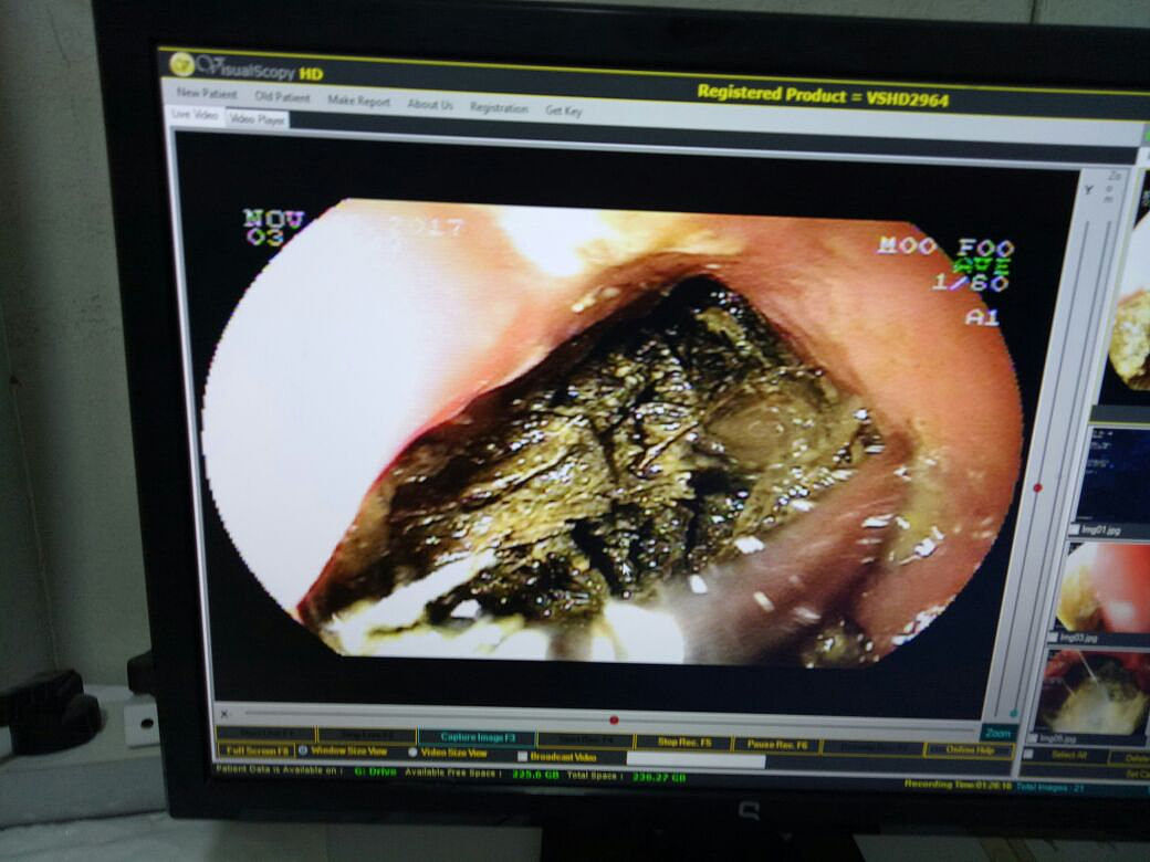 乙状结肠管状腺瘤症状及治疗方法 - 全面解析