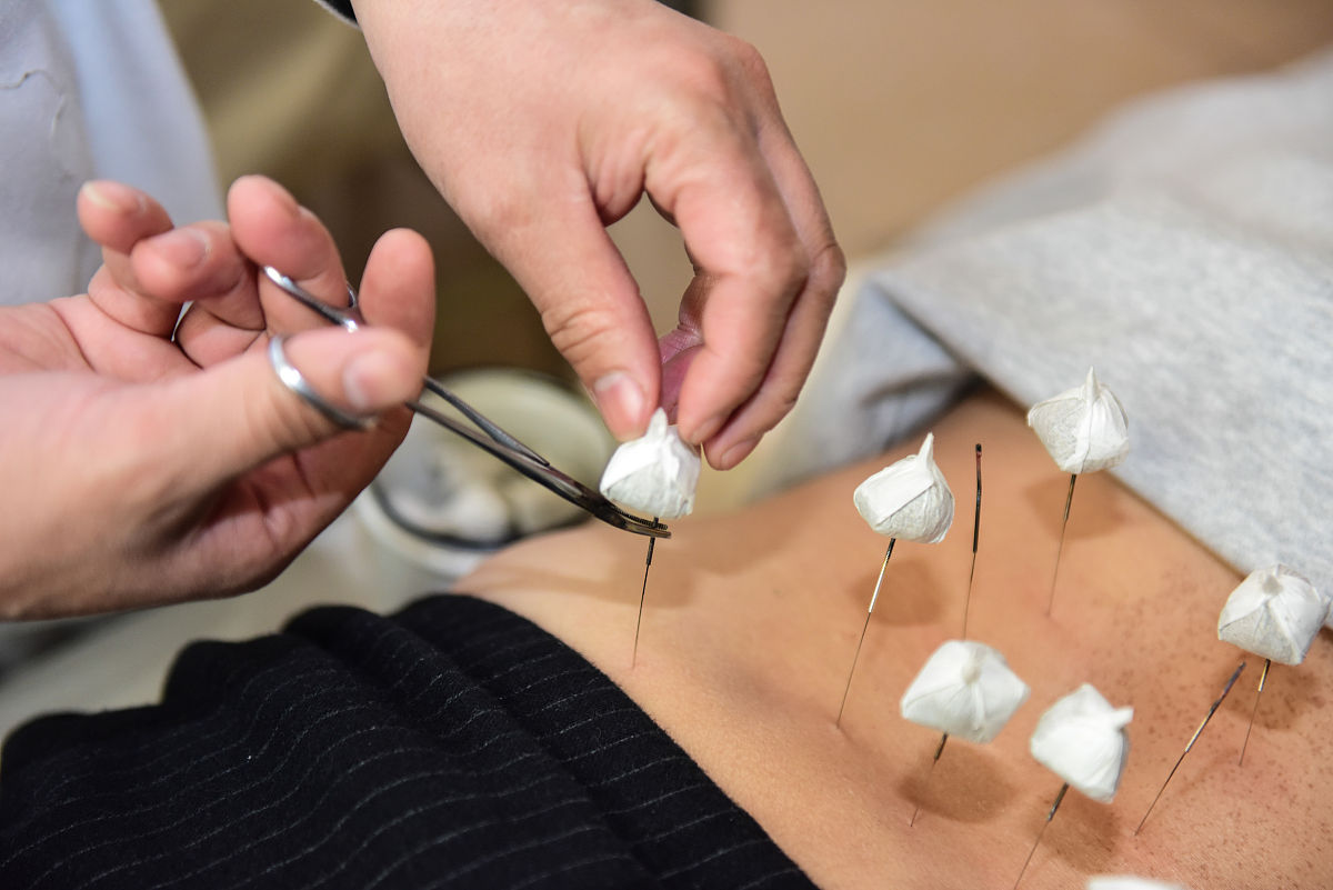 针灸治疗腰椎间盘突出好吗？优势有哪些？-专业医生解读