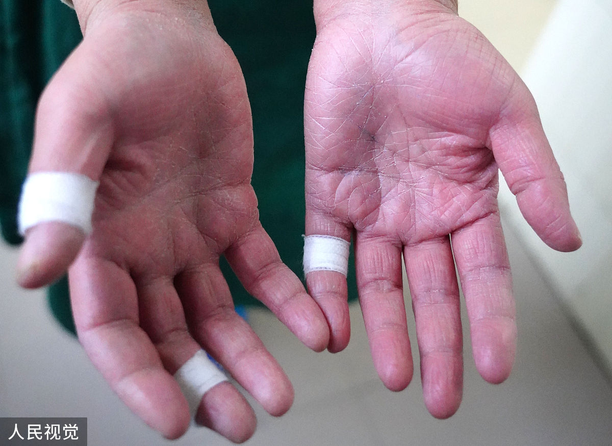 手长泡疹是什么原因手长泡疹可能由多种原因引起包括过敏、接触性皮炎、病毒感染、真菌感染、药物反应等。其中最常见的原因是接触性皮炎即皮肤接触到某些过敏原或刺激物质后引起的炎症反应。其他原因包括手足口病、天花、水痘、带状疱疹等病毒感染以及真菌感染如手癣等。药物反应也可能引起手长泡疹例如某些抗生素、非甾体抗炎药等。因此如果出现手长泡疹应及时就医并找出病因。继续