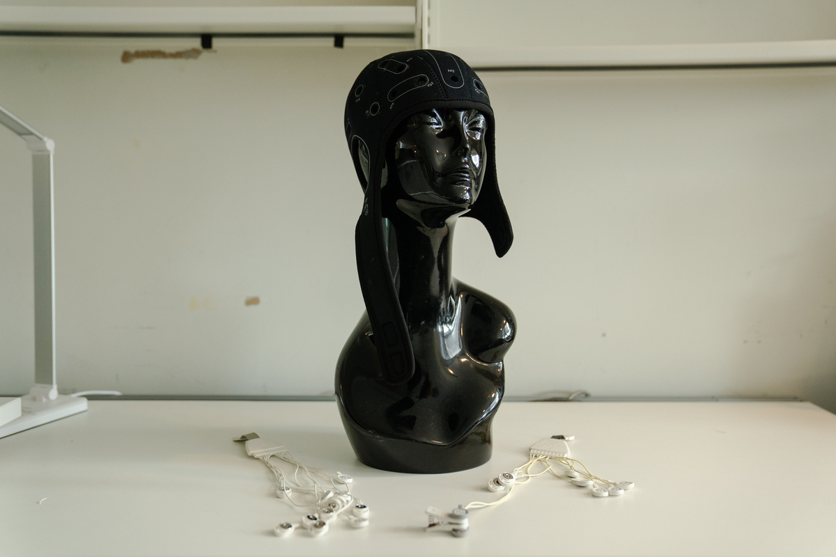 Carotid Artery Plaque Rupture and Floating Thrombus Formation: A Case Study and Treatment