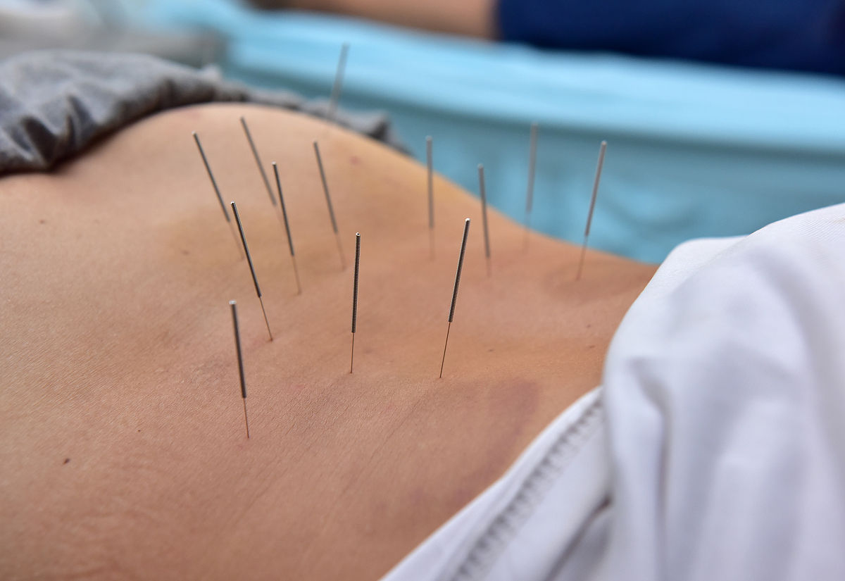 腹股沟疝气手术治疗指南: 开放式、腹腔镜、网片等多种术式详解