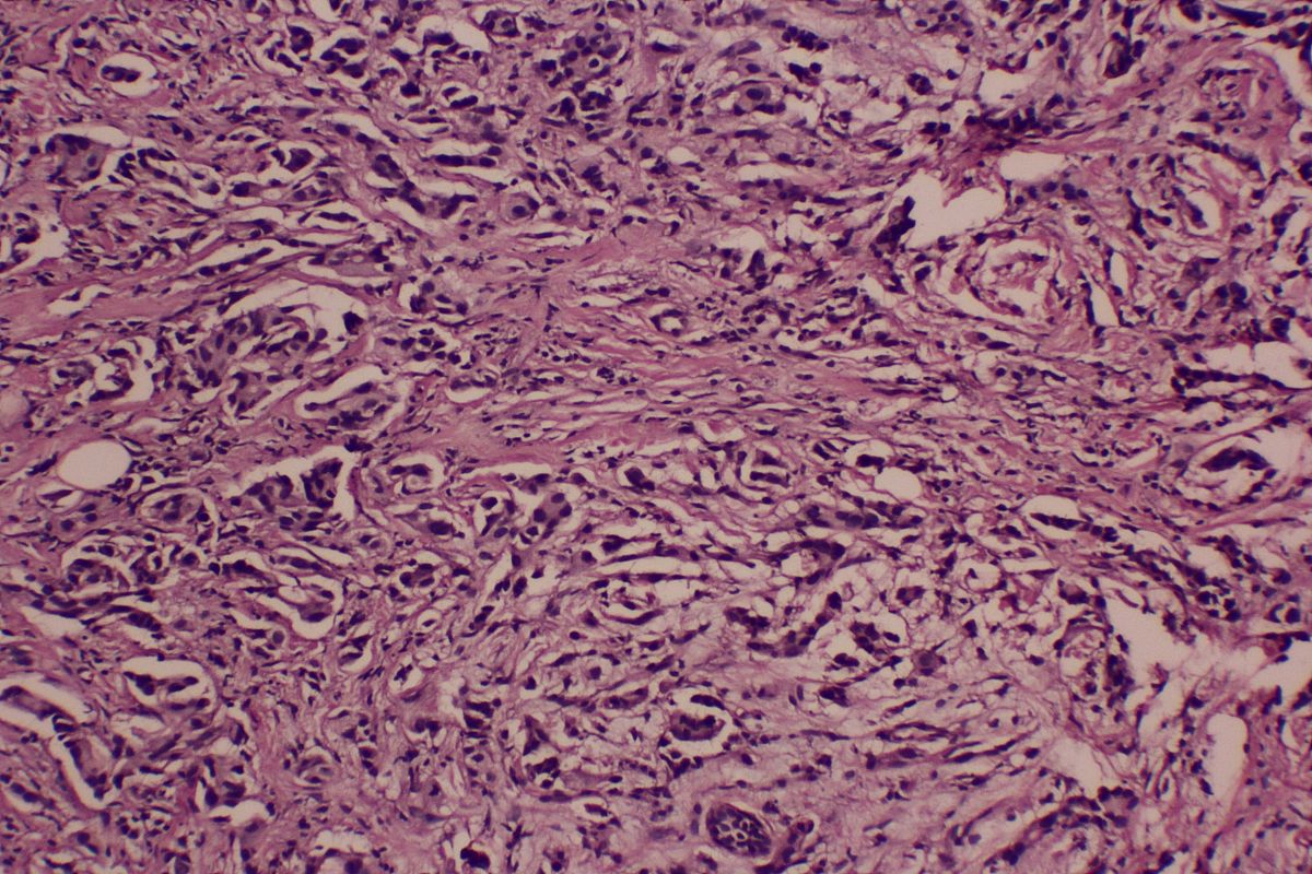 病理诊断Dixon术切除标本直肠隆起型高分化腺癌Well differentiatedadenocarcinoma伴产粘液大小5x35x15cm浸润肠壁达外膜纤维脂肪组织有浆膜被覆处未突破间皮层。肿瘤内部及周边轻度淋巴细胞反应可见神经侵犯未见脉管癌栓。肿瘤出芽为Bd1低级别出芽。手术最近环周切缘及另送吻合口近端、吻合口远端大肠壁均净。淋巴结肠周011及另送253LN01未见癌转移。IHCCK20+ 病理诊断Dixon术切除标本直肠隆起型高分化腺癌Well differentiatedadenocarcinoma伴产粘液大小5x35x15cm浸润肠壁达外膜纤维脂肪组织有浆膜被覆处未突破间皮层。肿瘤内部及周边轻度淋巴细胞反应可见神经侵犯未见脉管癌栓。肿瘤出芽为Bd1低级别出芽。手术最近环周切缘及另送吻合口近端、吻合口远端大肠壁均净。淋巴结肠周011及另送253LN01未见癌转移。IHCCK20+