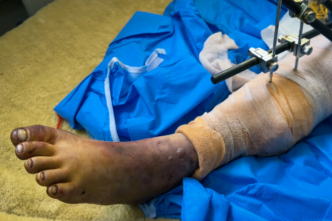 以急性跟腱断裂的手术治疗为题写五百字