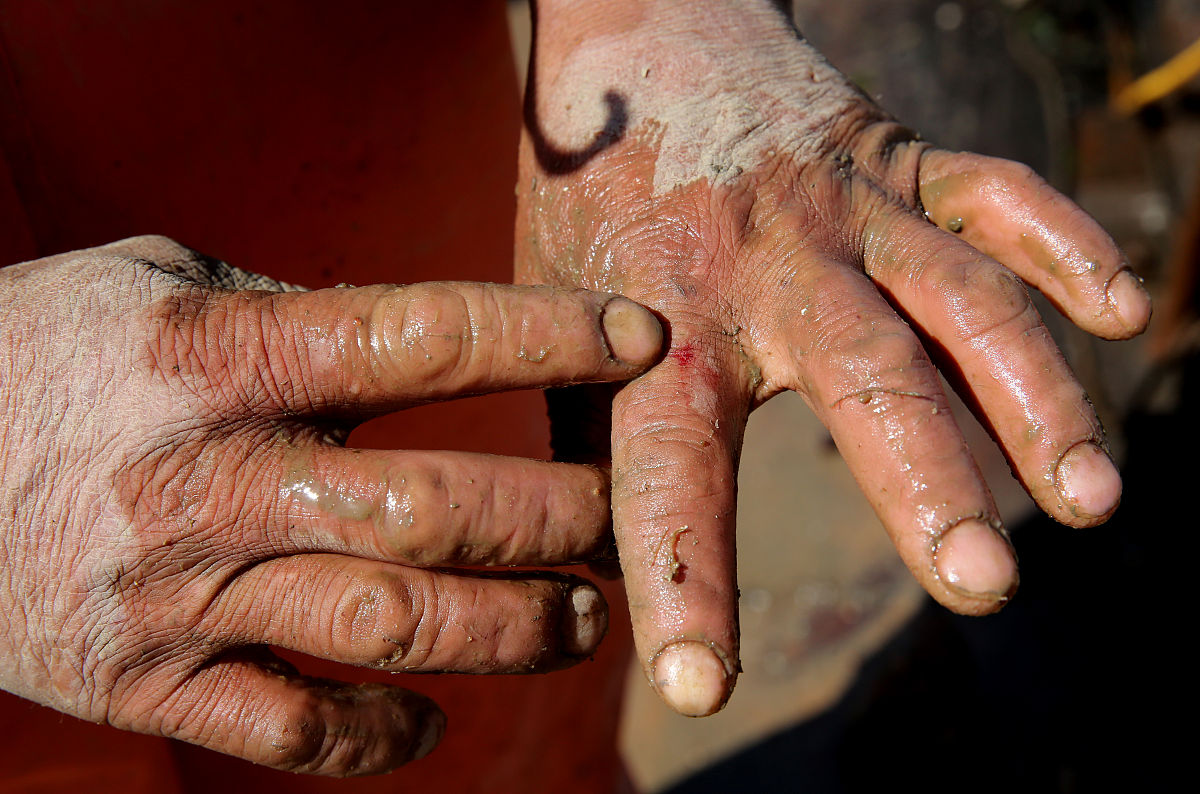 火碱烧伤怎么办？手被火碱腐蚀后的紧急处理方法