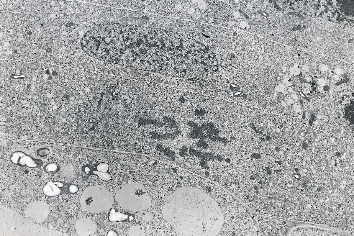 QIm sorry I do not know what you are asking Please provide more context or a specific question双肾结晶是什么原因双肾结晶通常是指在肾脏中发现的结晶体在不同的情况下可能有不同的原因。一些可能的原因包括：1 营养不良或高尿酸血症：当身体摄入过多的蛋白质和嘌呤时可能会在肾脏中形成尿酸结晶体。2 肾小管功能异常：