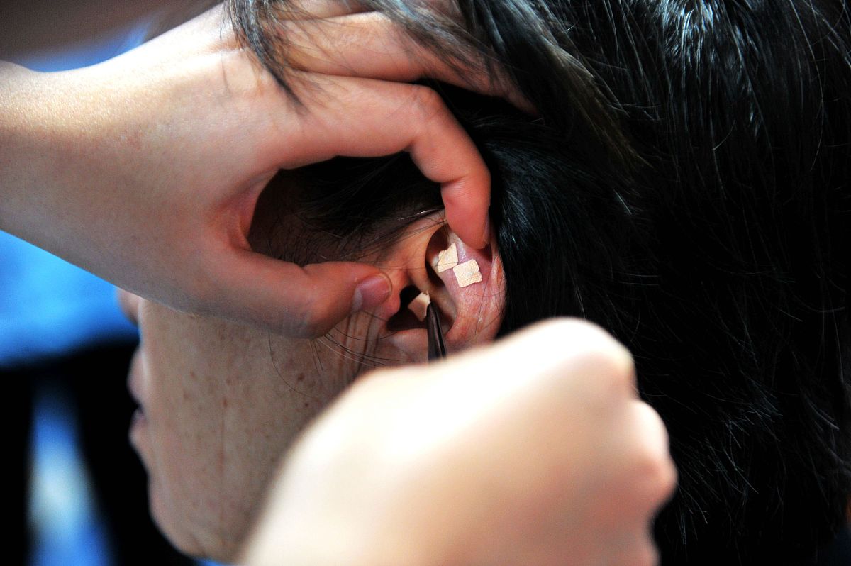 国产耳穴：了解中国耳穴针、耳贴等产品