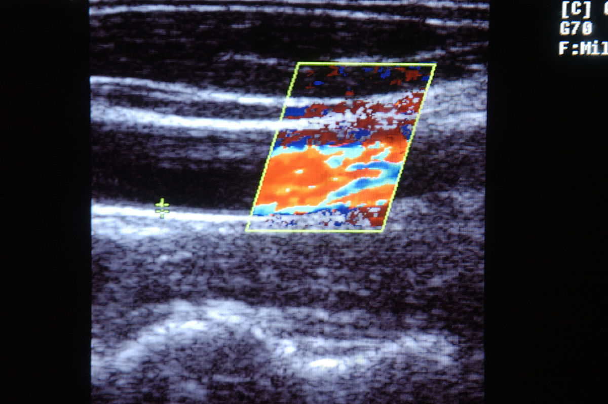 翻译：Our meta-analysis of comparative studies included six studies reporting head-to-head direct comparisons of the diagnostic performance of HCC of ACR CEUS LI-RADS algorithms and modified CEUS LI-RADS