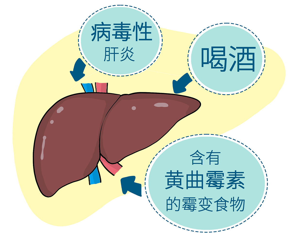 胰腺癌形成的原因确诊后的存活时间