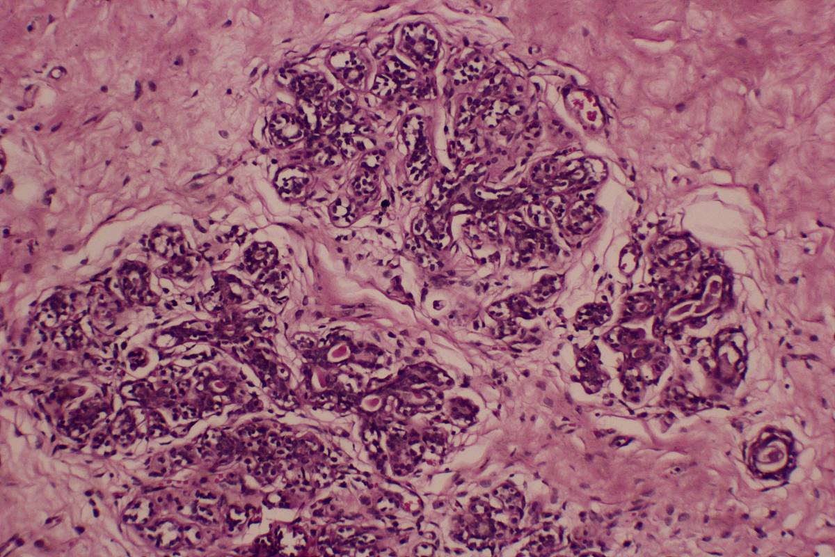 乳腺癌转移部位及治疗方法：骨骼、肺部、肝脏、大脑