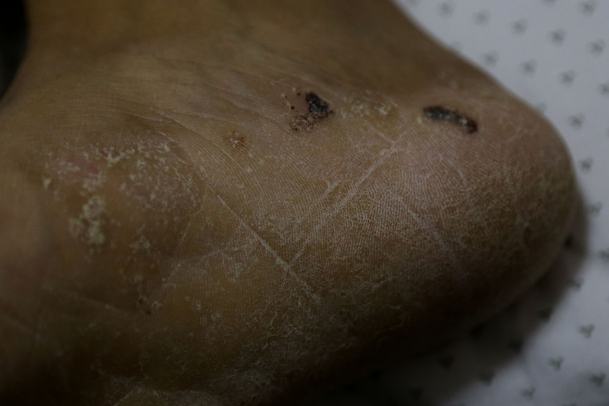 黑鸡皮怎么治疗