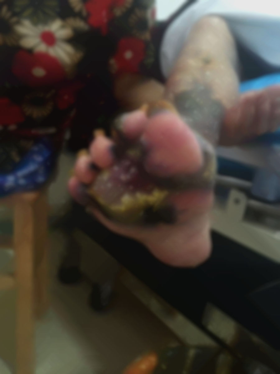 后脚跟溃烂可能是真菌感染应该怎么治疗