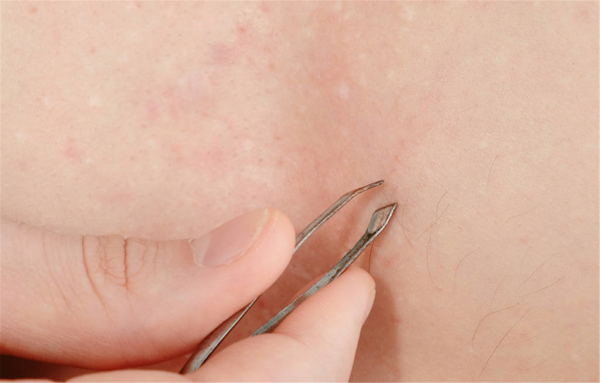 肚子上的毛怎么永久去掉 #医美科普挑战赛# 肚子上的毛发困扰了很多人