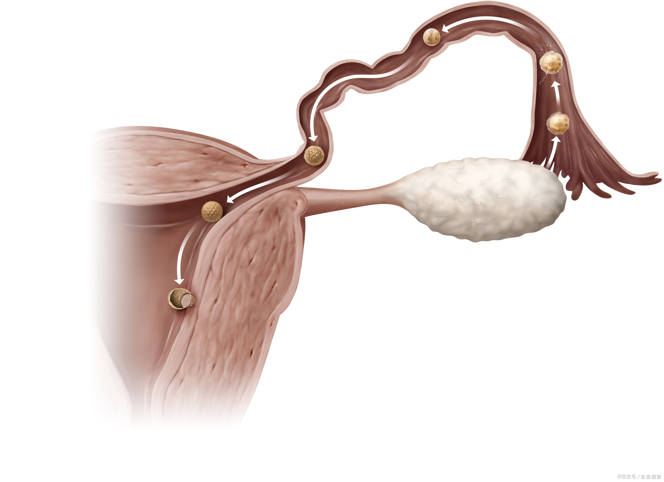 宫腔内囊性结构图片