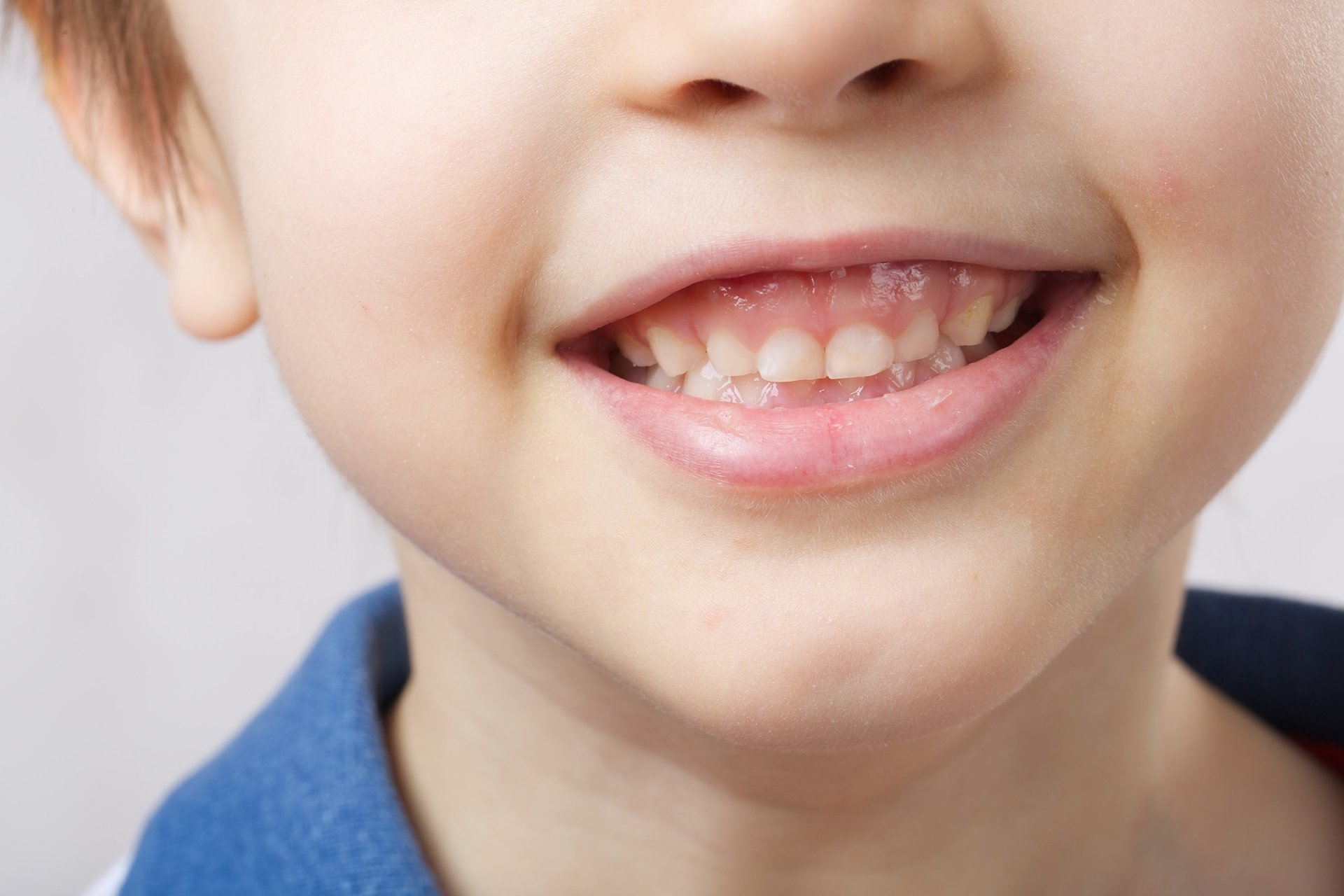 当产生蛀牙的时候,牙齿颜色会变的不均匀,蛀牙的部位会变成黑色或者