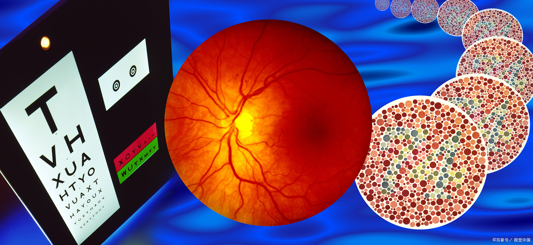 糖尿病眼底视网膜病变中医辨证五种类型及方剂