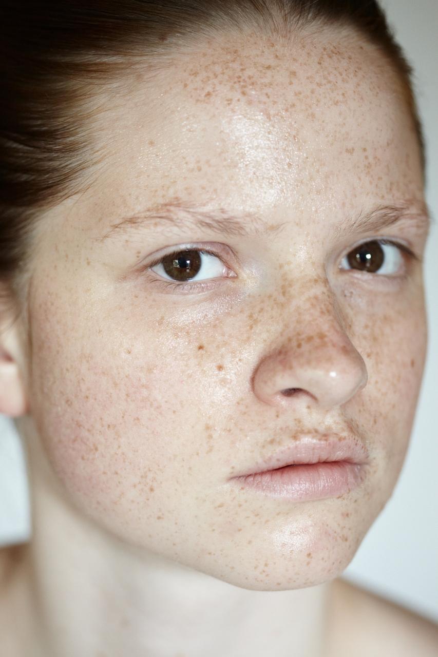 脸上晒斑的去除方法:绽放亮丽肌肤 太阳的强烈阳光不仅让我们的皮肤