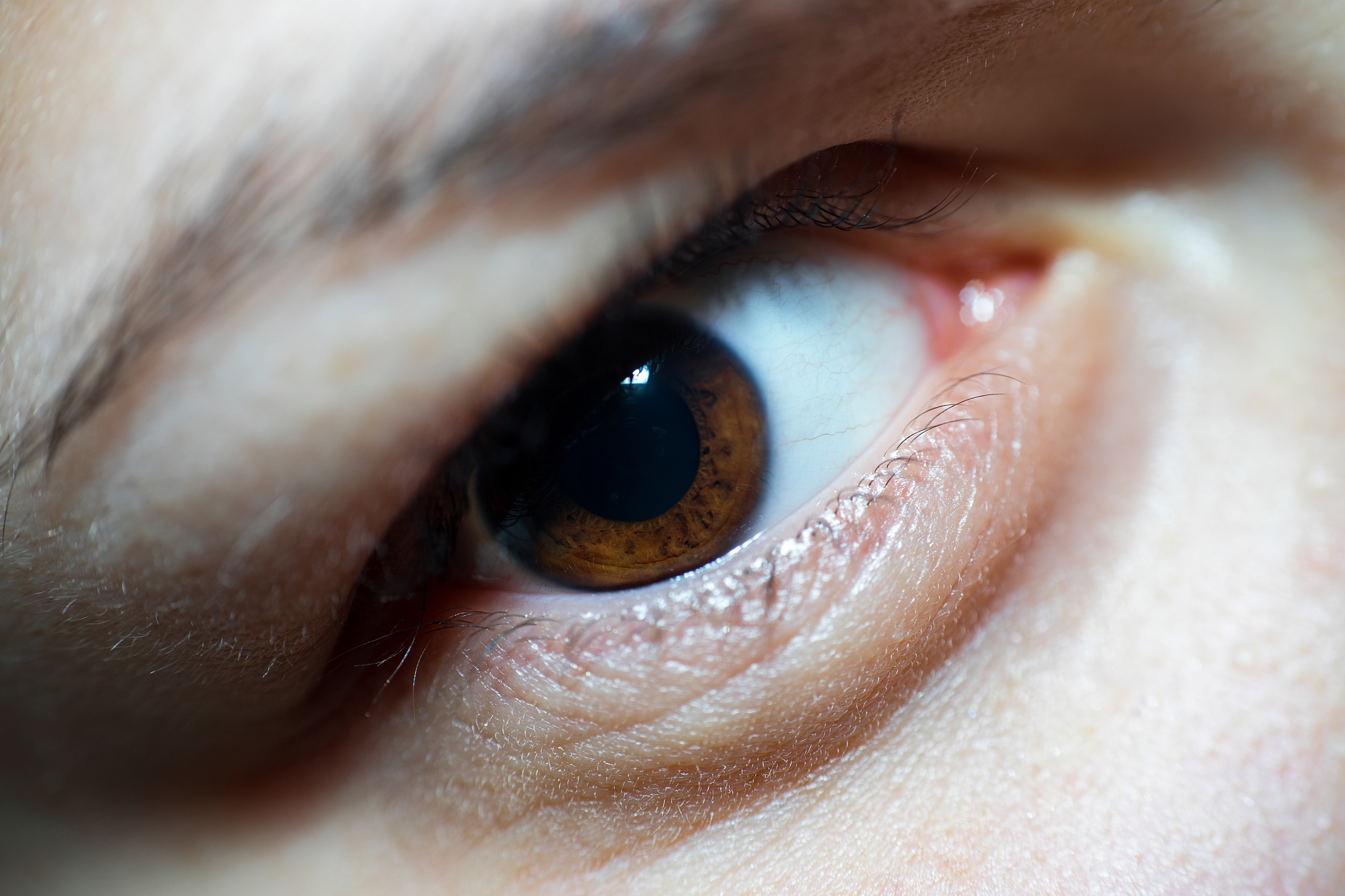 倒睫毛的出现影响了眼部健康,采用合适的手术方案可以予以矫正