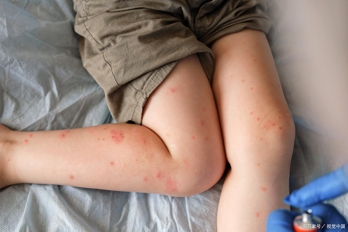 被蚊子叮了为什么会起水泡为什么在线 被蚊子叮了为什么会起水泡为什么在线