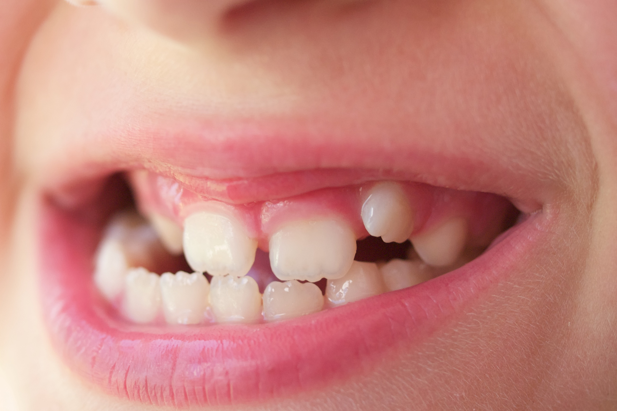 孩子牙齿波浪形的原因可能是牙齿正常发育,钙元素缺乏或长期咀嚼过硬