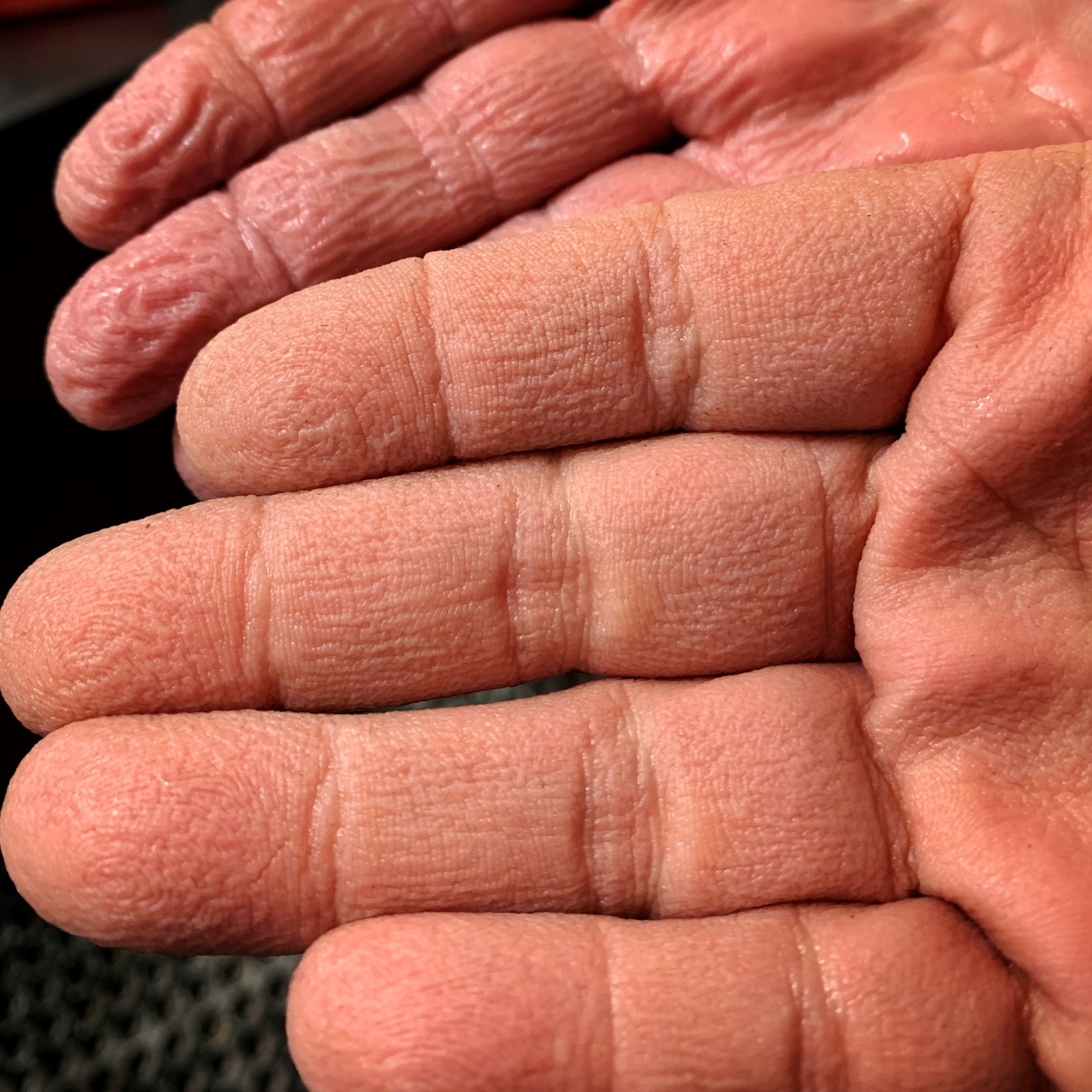 手脱皮是什么原因导致的?