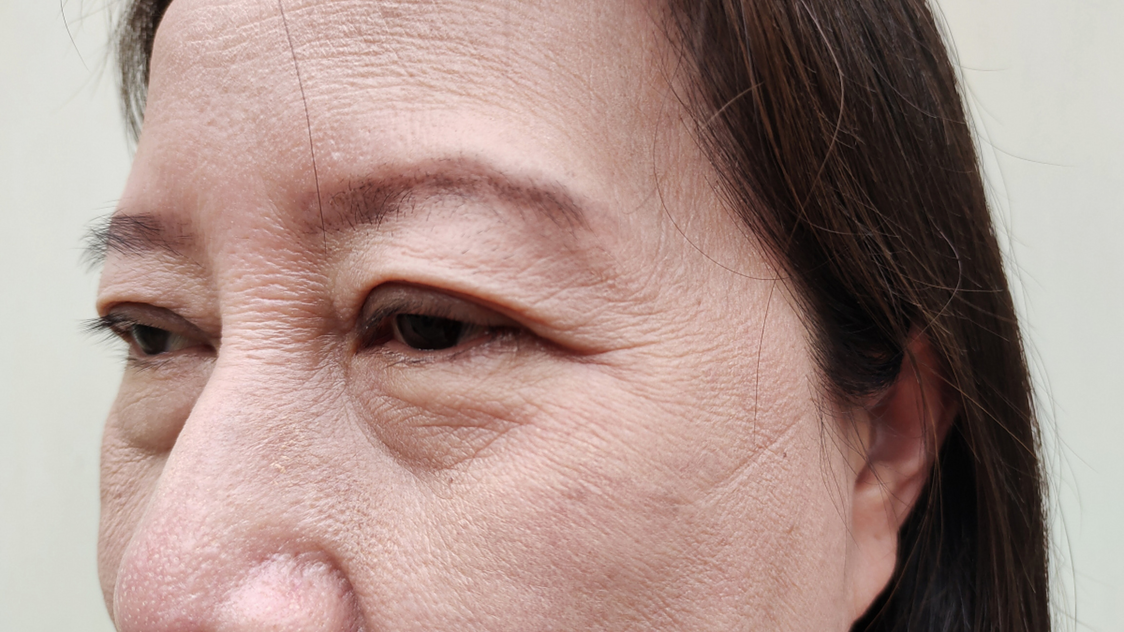 皮肤松弛?皮肤是我们身体的外层保护层,对整体外观起着重要的作用.