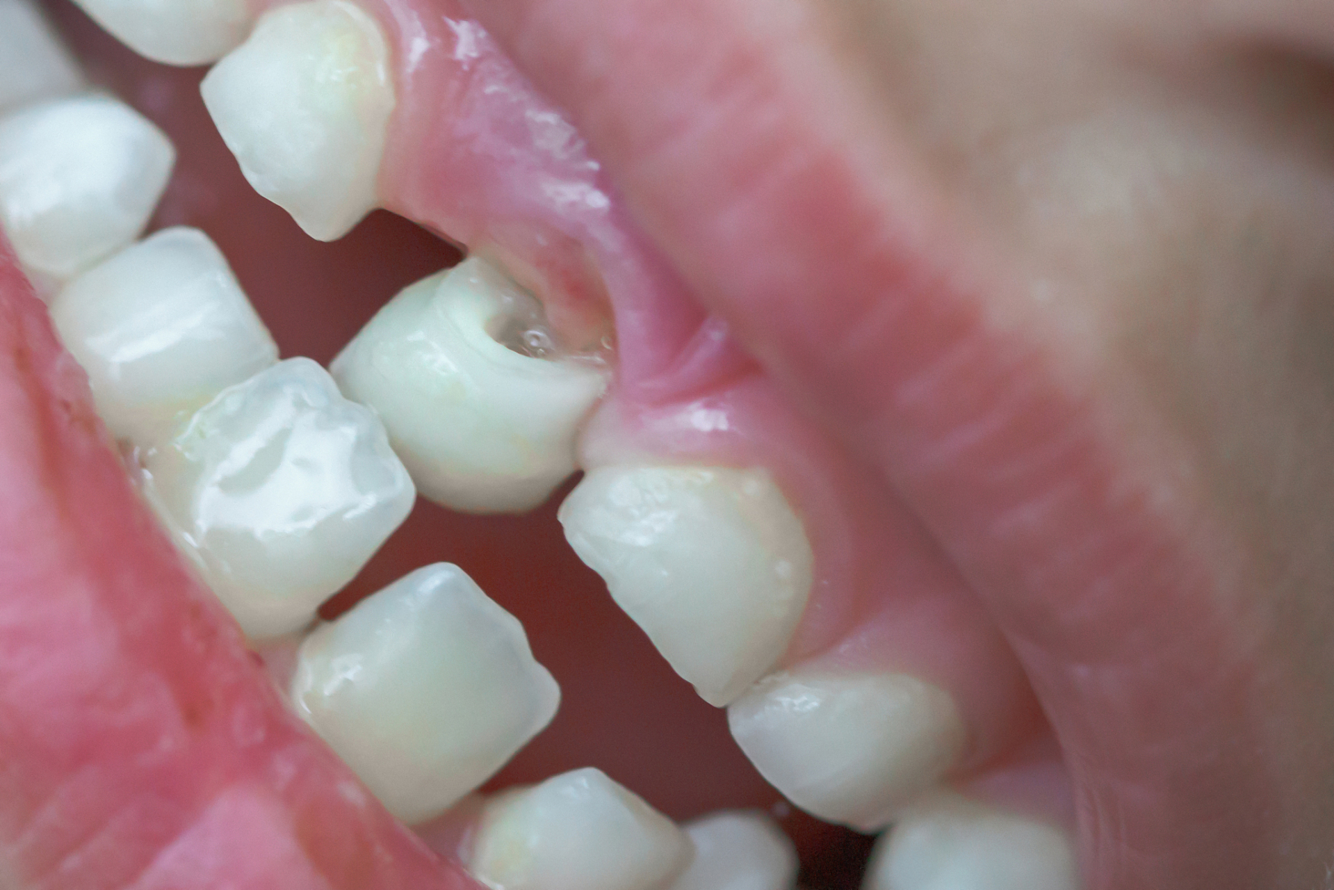 乳牙滞留,就是恒牙应该长出来的时候,乳牙却迟迟不肯脱落.