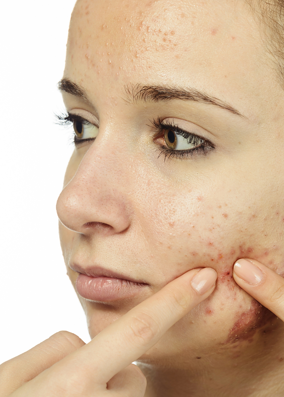 痘痘肌怎么根治  痘痘肌是指易长痘痘的肌肤类型,常常伴随着面部出现