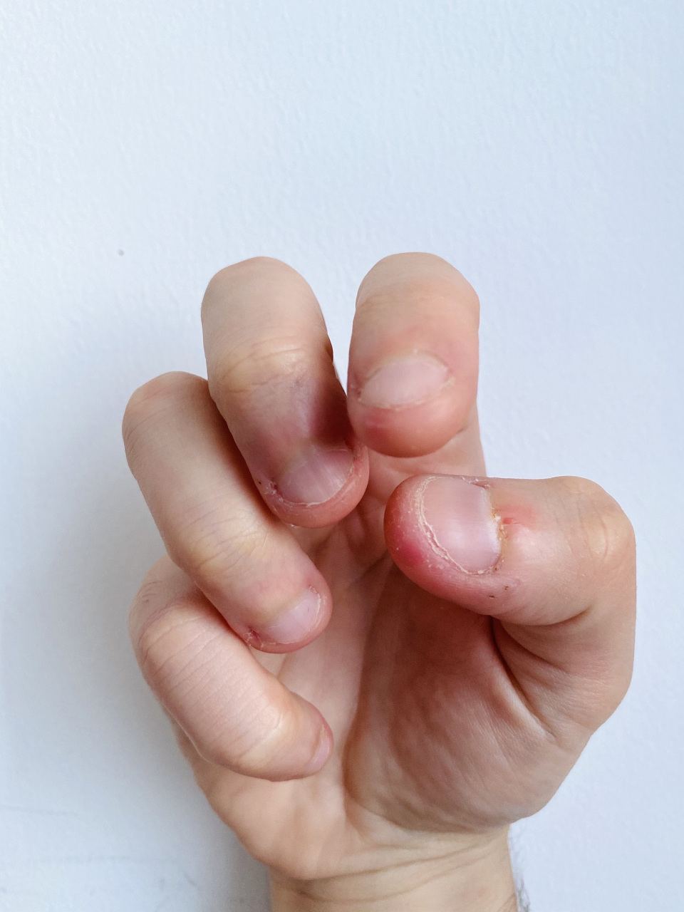 虽然维生素的缺乏可以导致指甲的异常,但甲周倒刺并非仅由维生素缺乏