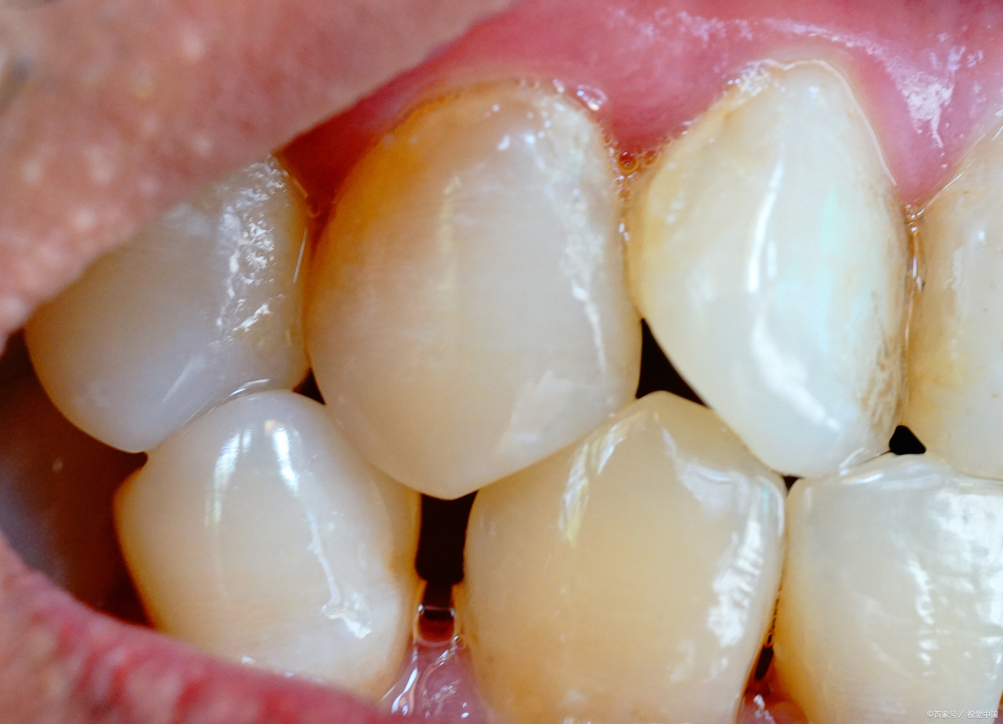 牙釉质一旦受损,无法像其他组织一样实现真正意义上的再生