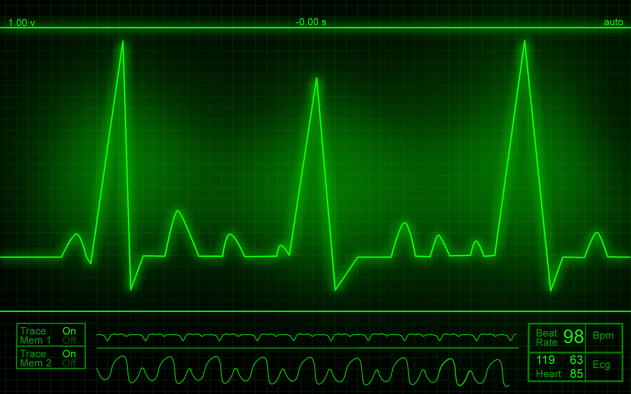 t波异常:揭秘心脏电波的隐秘信号 t波异常是心电图检查中常见的现象