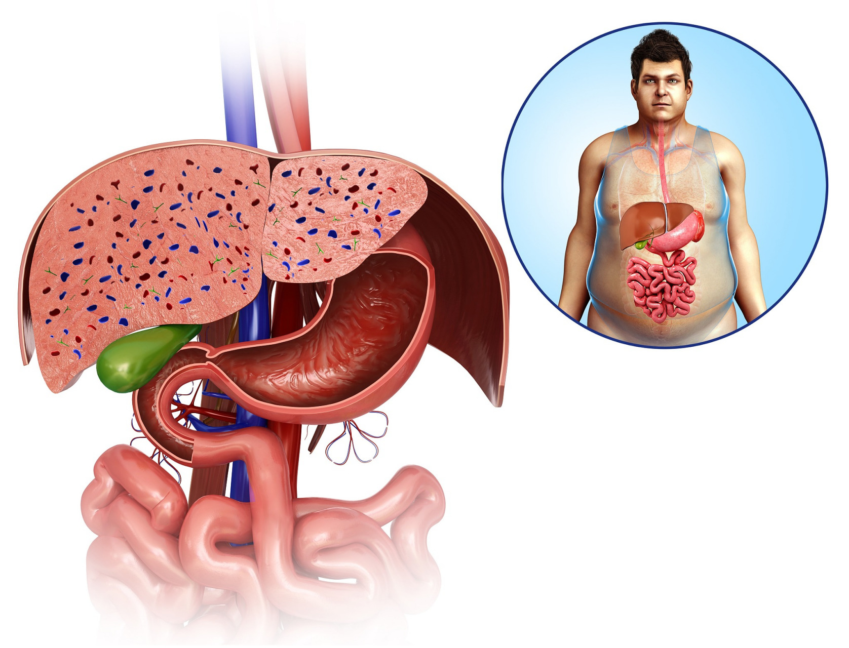 重症胰腺炎:一个年轻生命的警示  昨天收治了一名29岁的年轻男子,因为