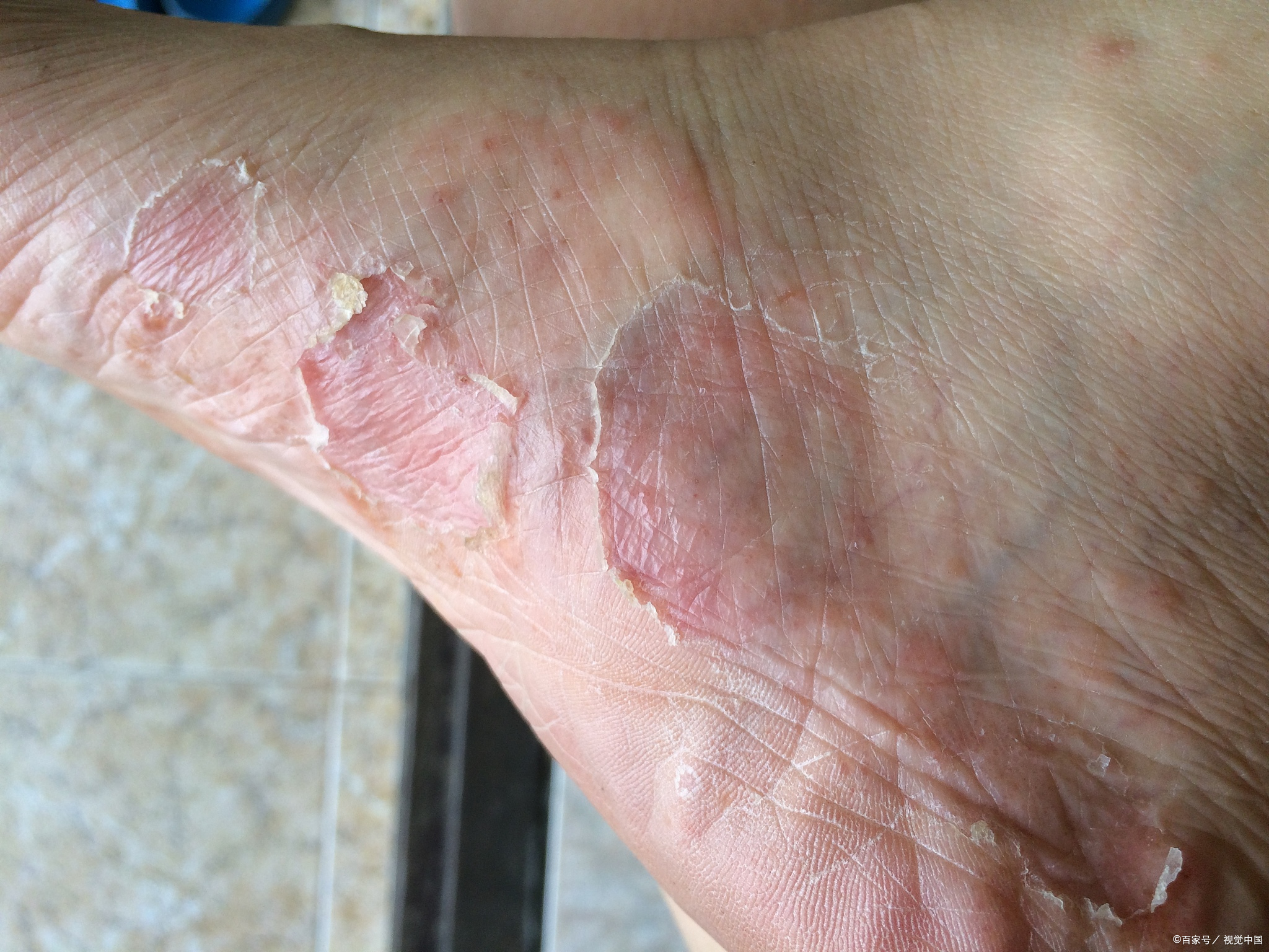 即足癣,是由皮肤癣菌感染引起的常见皮肤病,但它通常主要发生在足部