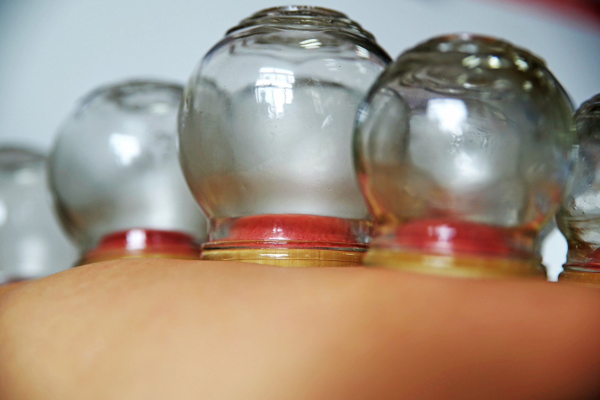 拔火罐是一种传统的中医疗法,被认为可以促进血液循环,缓解疼痛等.