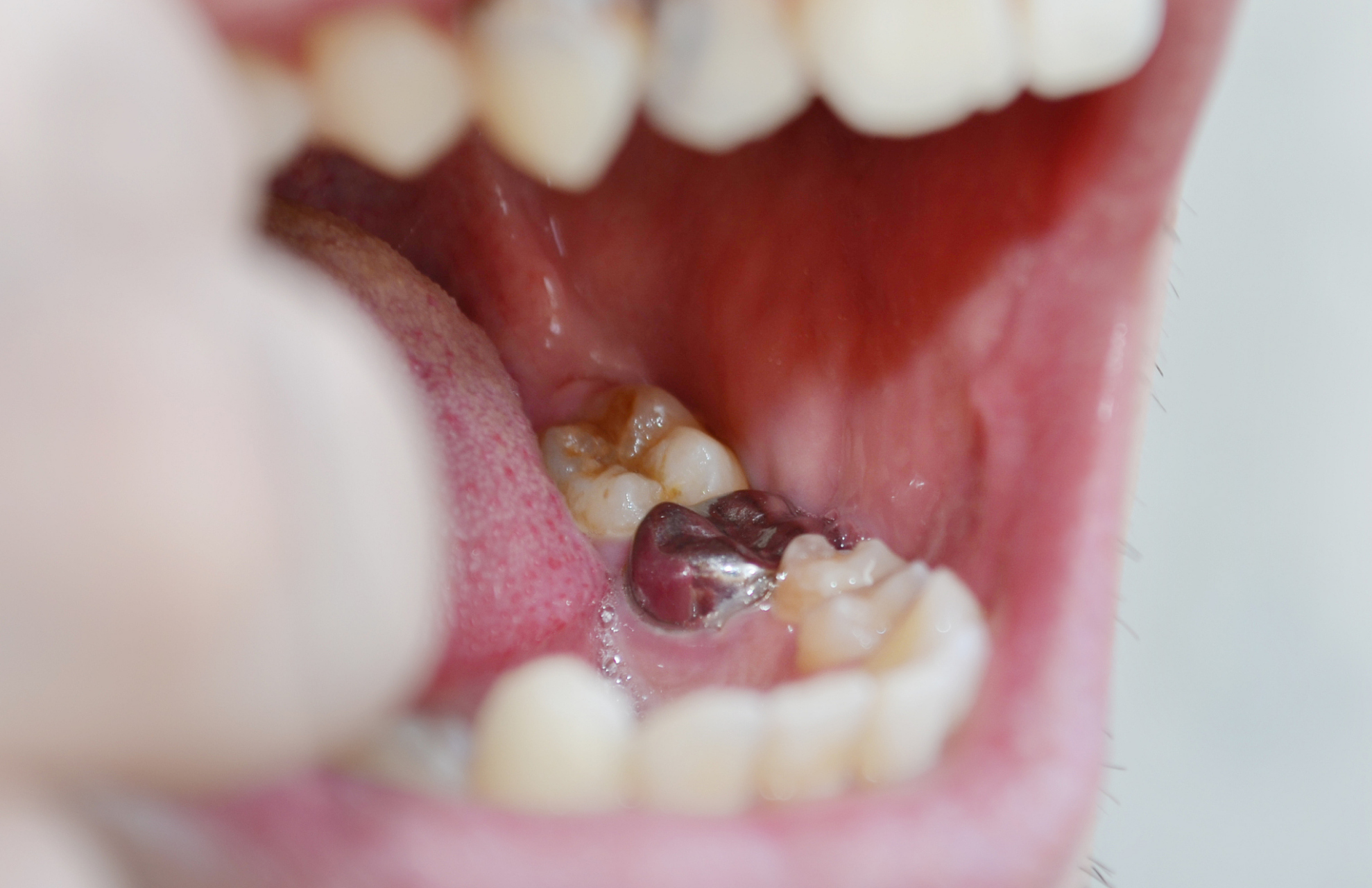 首先,智齿发炎的情况下一般会出现牙龈红肿,疼痛,这时需要及时控制