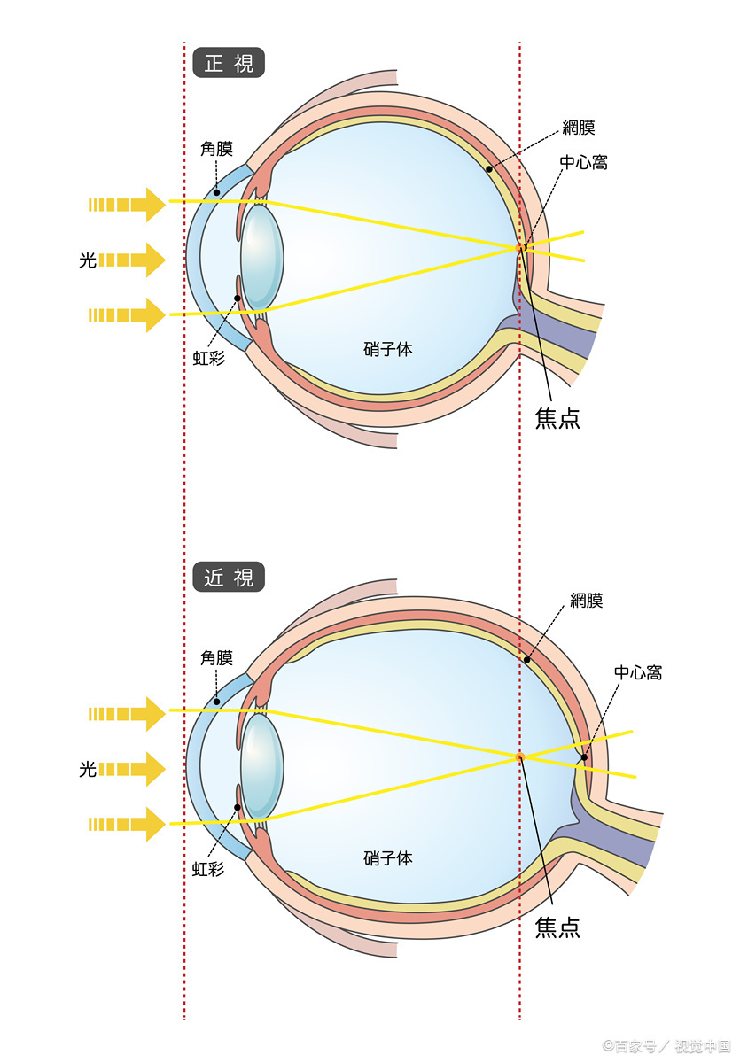 近视度数加深的三大原因,如何通过复查预防视力问题?