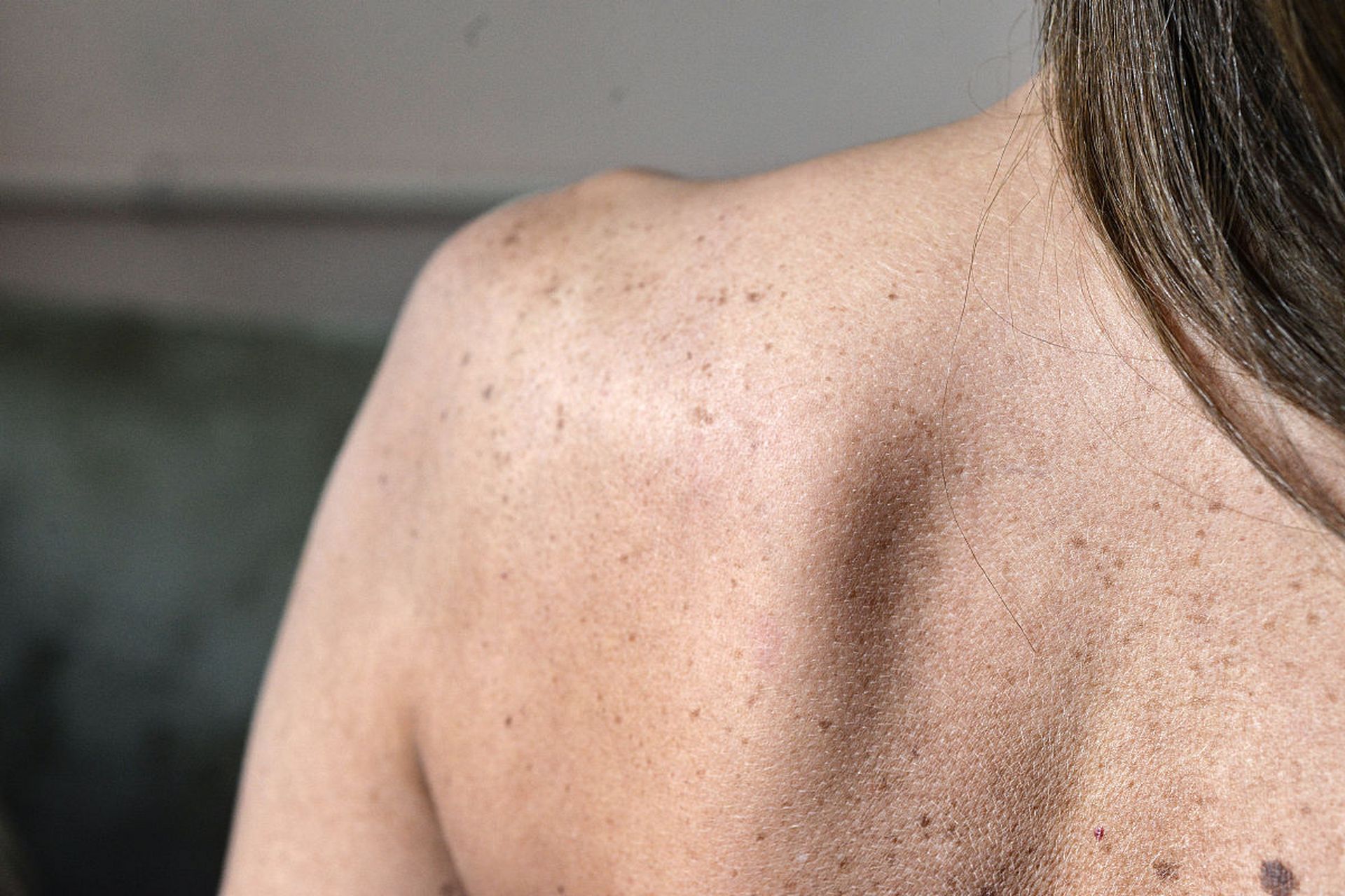 60岁的女人后背长了一块块白斑 #老人# #长斑# #白癜风#    60岁的