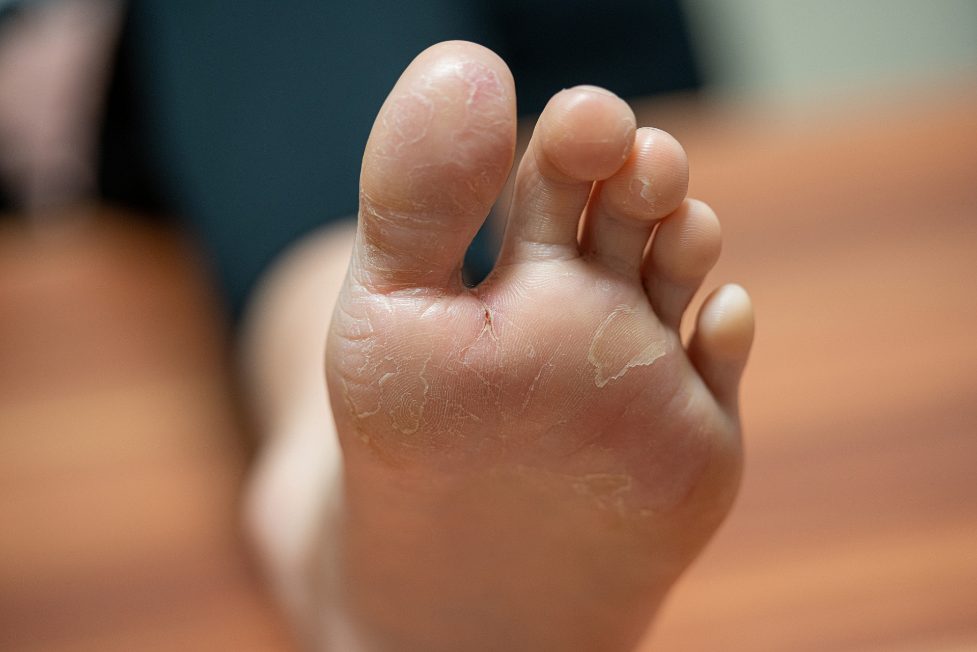 日常生活中还需要注意以下问题:  一,保持足部干燥  脚癣的真菌喜欢