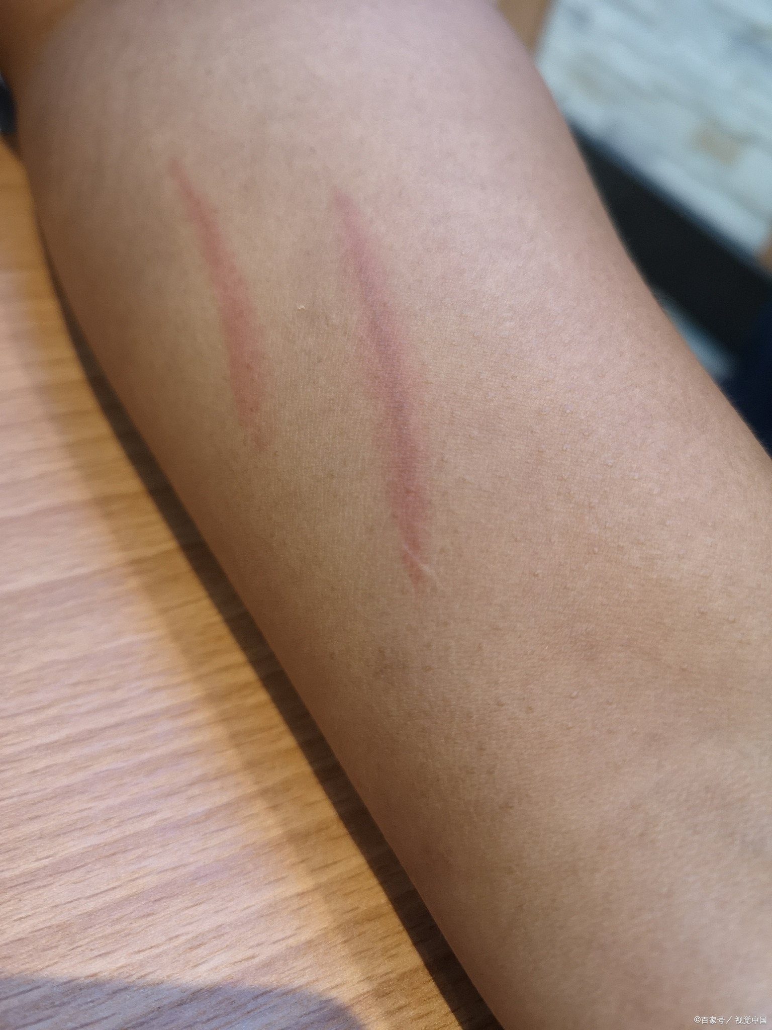 如何确认是否被狗抓伤?被狗抓伤后应该怎么处理?