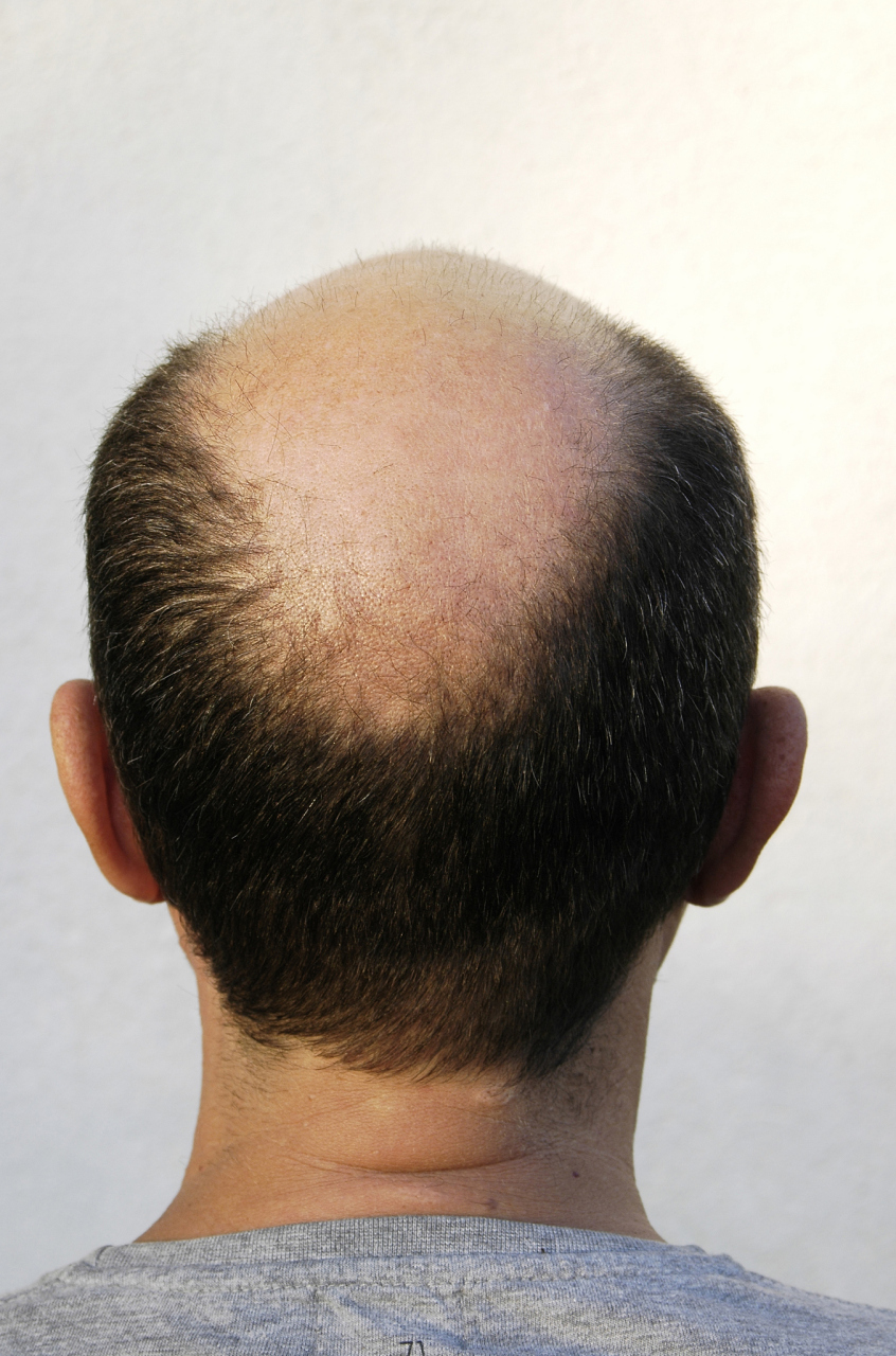 脂溢性脱发,早秃) 雄激素性脱发(aga) 1,是脱发中最常见的脱发类型