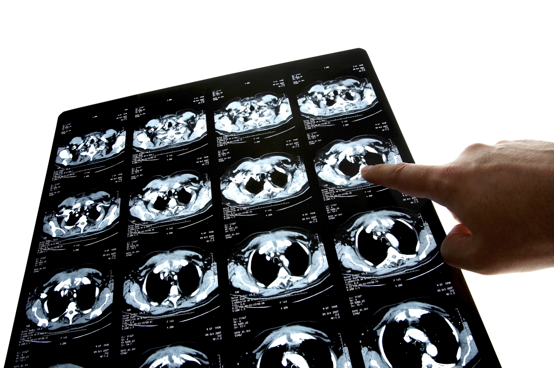 什么情况下需要做心脏ct,你都知道吗?