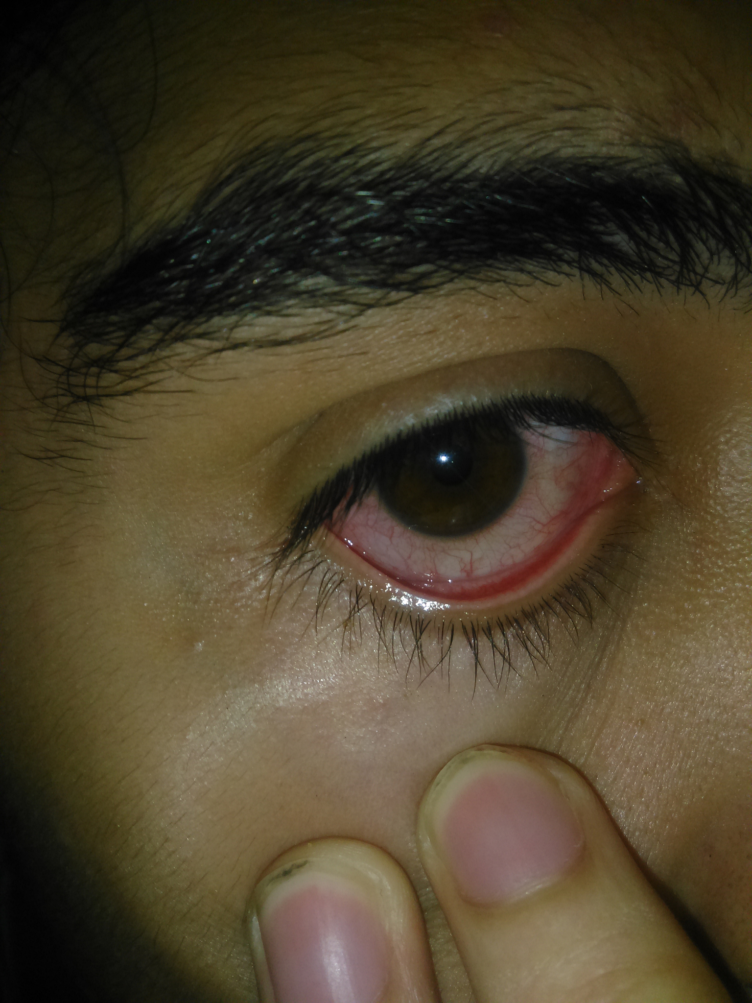 它是眼睑腺体的急性化脓性炎症,多由葡萄球菌感染引发.当身体抵